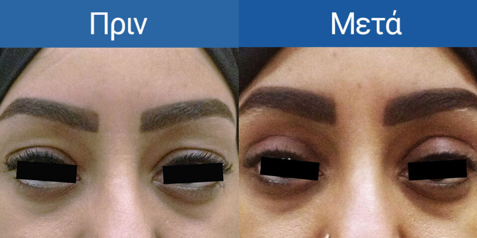 Blepharoplasty-1