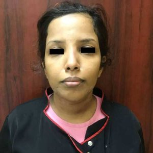 lipoanakiklosi-meta-1