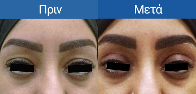 Blepharoplasty-1